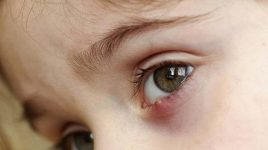 11 داروی خانگی برای درمان گل مژه چشم را بشناسید