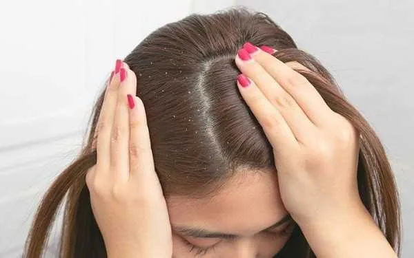 ارتباط شوره سر با بیماری کبد چرب
