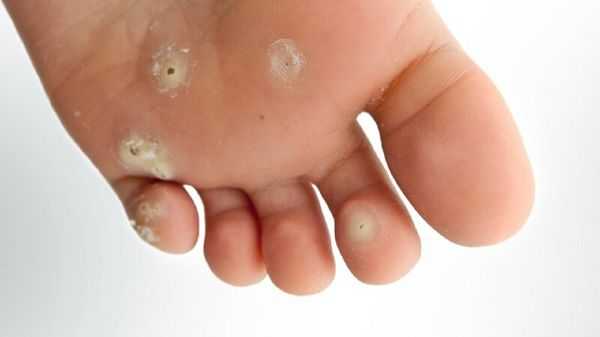 با علائم پوستی دیابت بیشتر آشنا شوید