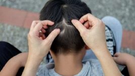 درمان خانگی شپش موی سر با اسپند