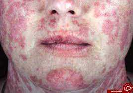 پاسخ به سوالات رایج درباره لوپوس