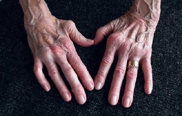 بیماری روماتیسم مفصلی چیست و چه علائمی دارد؟