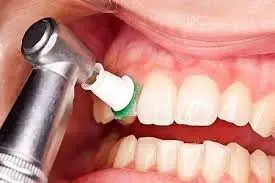 آیا جرم&zwnj;گیری به مینای دندان آسیب می&zwnj;زند؟