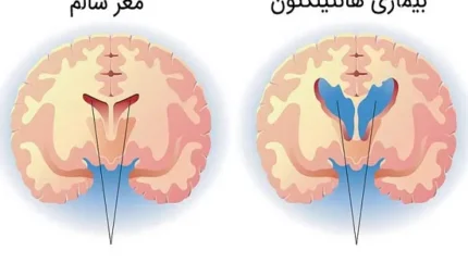 بیماری هانتیگتون