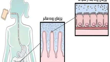 بیماری سلیاک