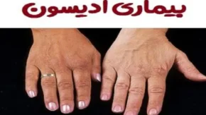 بیماری آدیسون