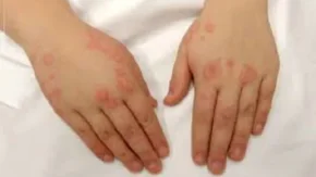 بیماری لوپوس و علائم