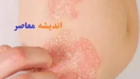 بیماری پسوریازیس چیه